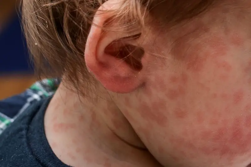 Ante la confirmacin de un caso de sarampin, Salud convoc a comisin de vigilancia