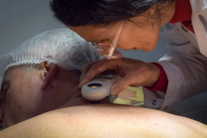 Salud promueve la consulta temprana de revisi�n de lesiones para prevenir el c�ncer de piel